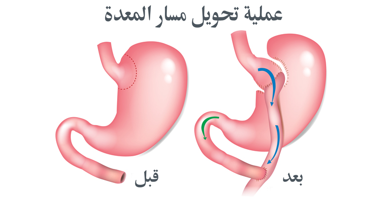 عملية تحويل المسار