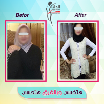 نزول في الوزن بعد عملية تكميم معدة