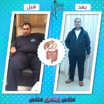 احدي عمليات السمن قبل وبعد